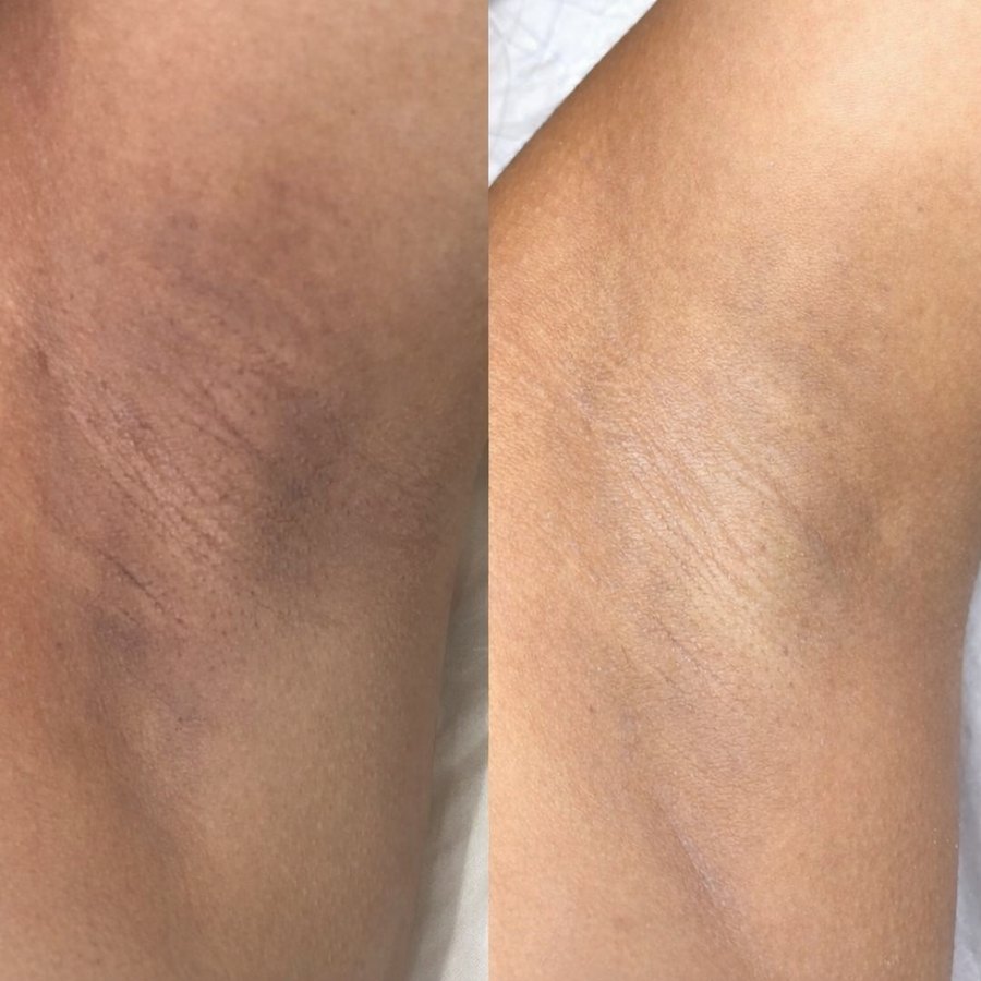 Antes e depois do clareamento de axila