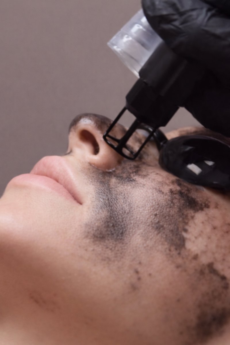 Peeling Hollywood com máscara de carbono e laser
